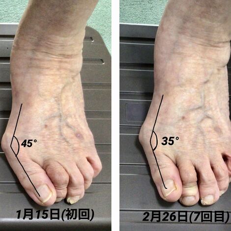 外反母趾